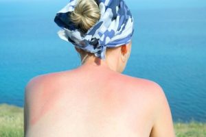 Hausmittel zur Sonnenbrand Behandlung