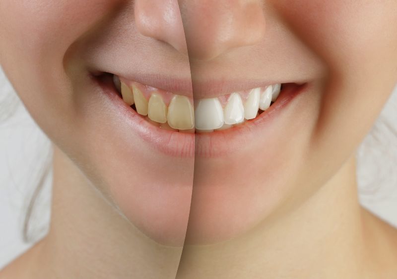 Vorteile & Gefahren von Bleaching der Zähne
