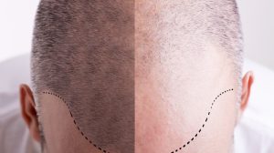 Haartransplantation