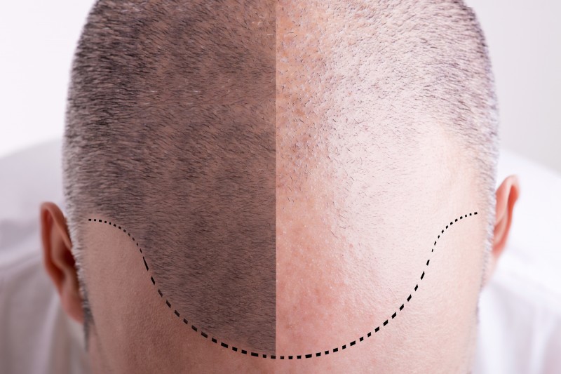 Haartransplantation