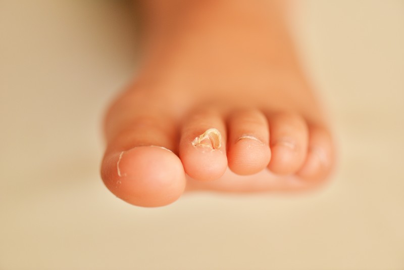 Nagelpilz Hausmittel